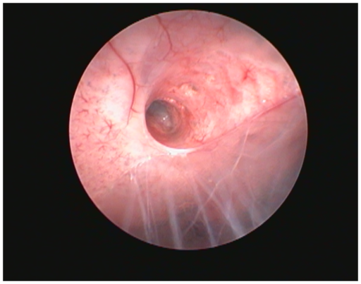 chronic pulmonary disease