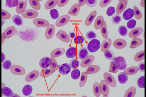 Hematology | Anemia