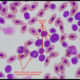 Hematology | Anemia